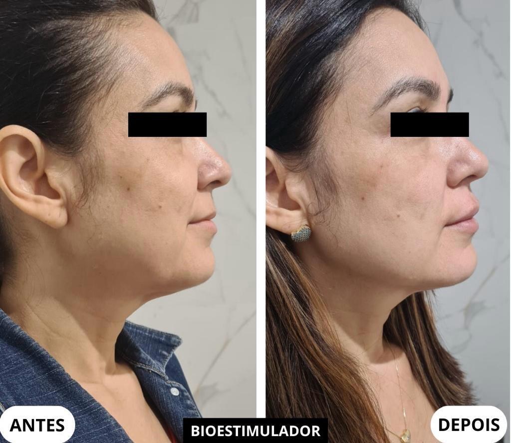 Resultado de bioestimulador na Botolifting São José do Rio Preto