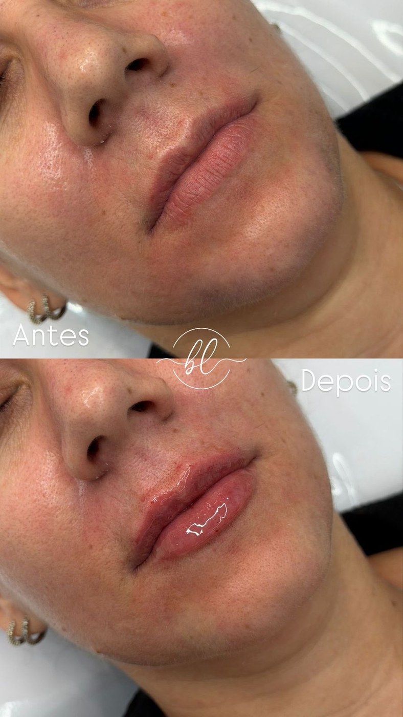 Resultado de preenchimento labial na Botolifting São José do Rio Preto