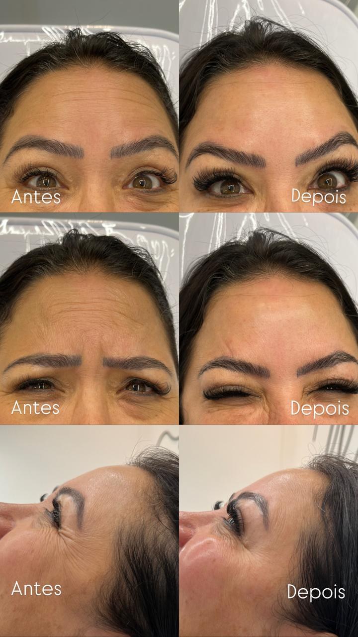 Resultado de botox na Botolifting São José do Rio Preto