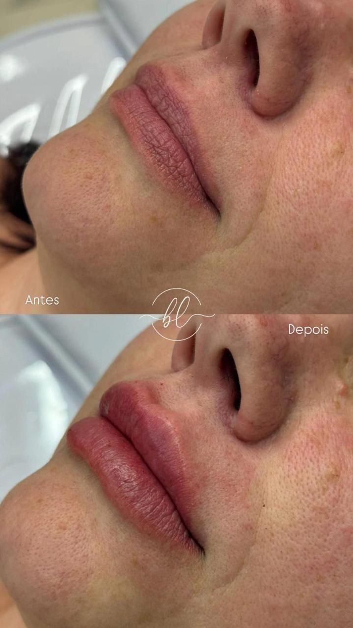 Resultado de preenchimento labial na Botolifting São José do Rio Preto