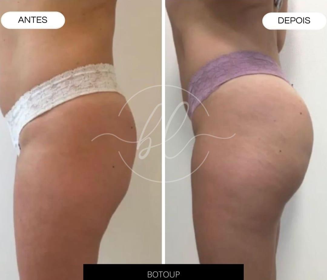 Resultado de preenchimento de glúteo na Botolifting São José do Rio Preto