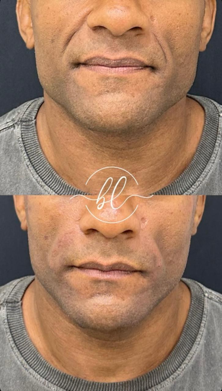 Resultado de preenchimento no bigode chinês na Botolifting São José do Rio Preto
