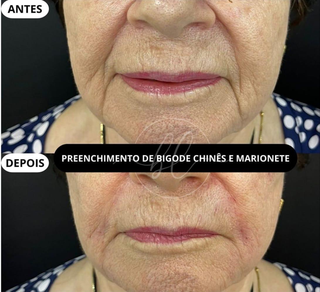 Resultado de preenchimento no bigode chinês na Botolifting São José do Rio Preto