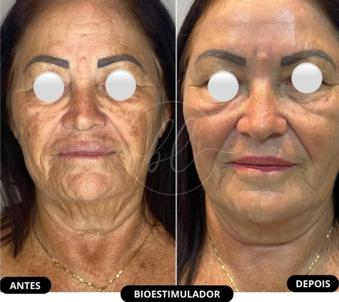 Resultado de bioestimulador na Botolifting São José do Rio Preto