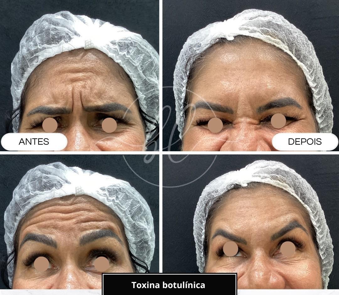 Resultado de botox na Botolifting São José do Rio Preto