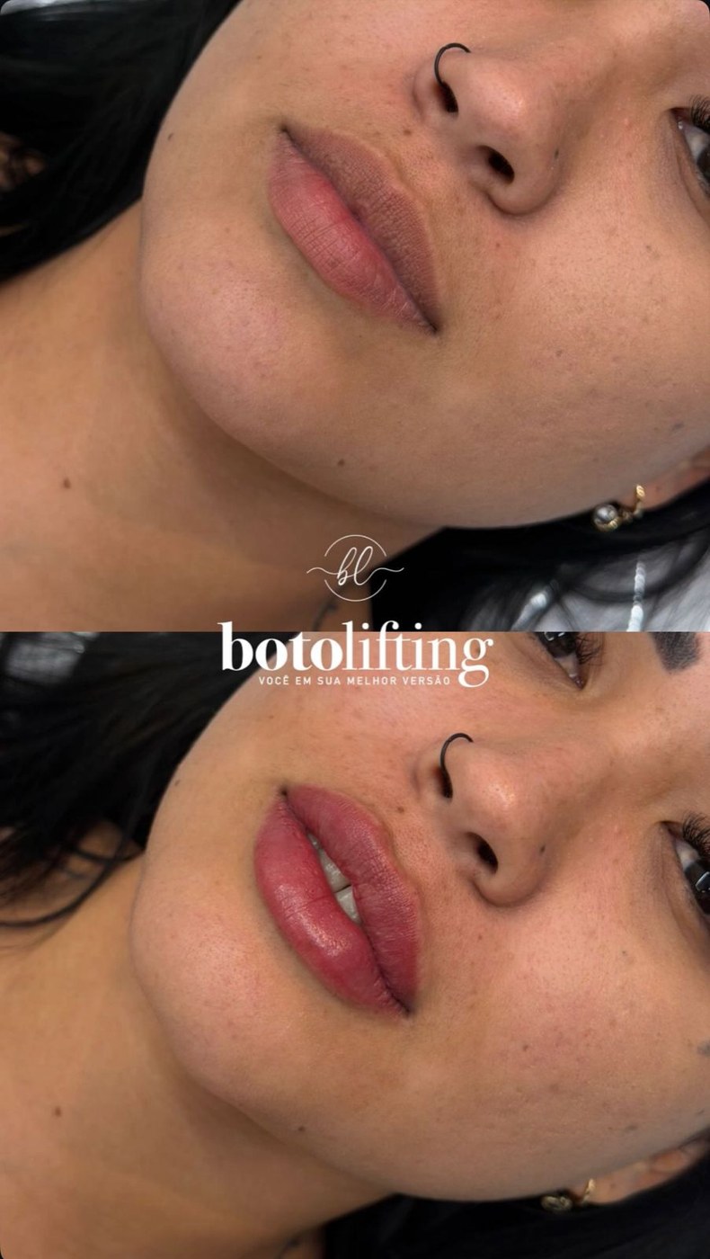 Resultado de preenchimento labial na Botolifting São José do Rio Preto