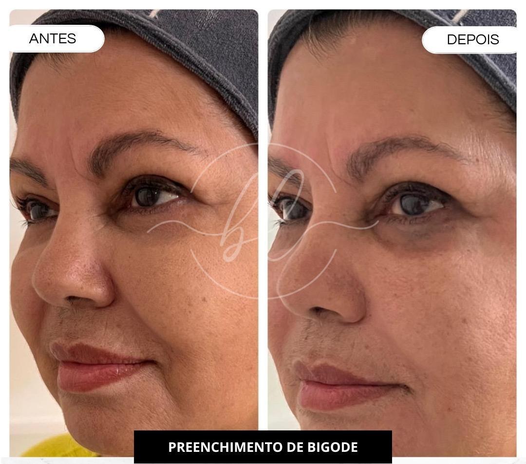 Resultado de preenchimento no bigode chinês na Botolifting São José do Rio Preto