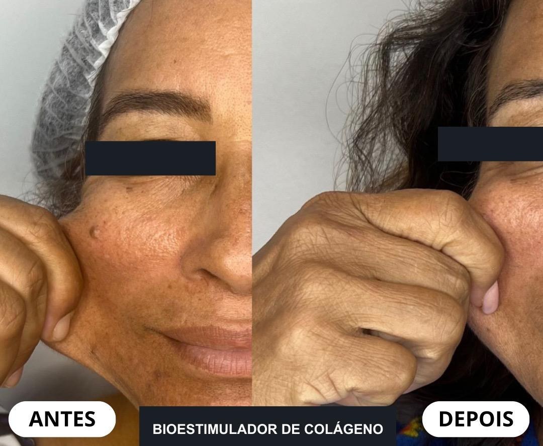 Resultado de bioestimulador de colágeno na Botolifting São José do Rio Preto