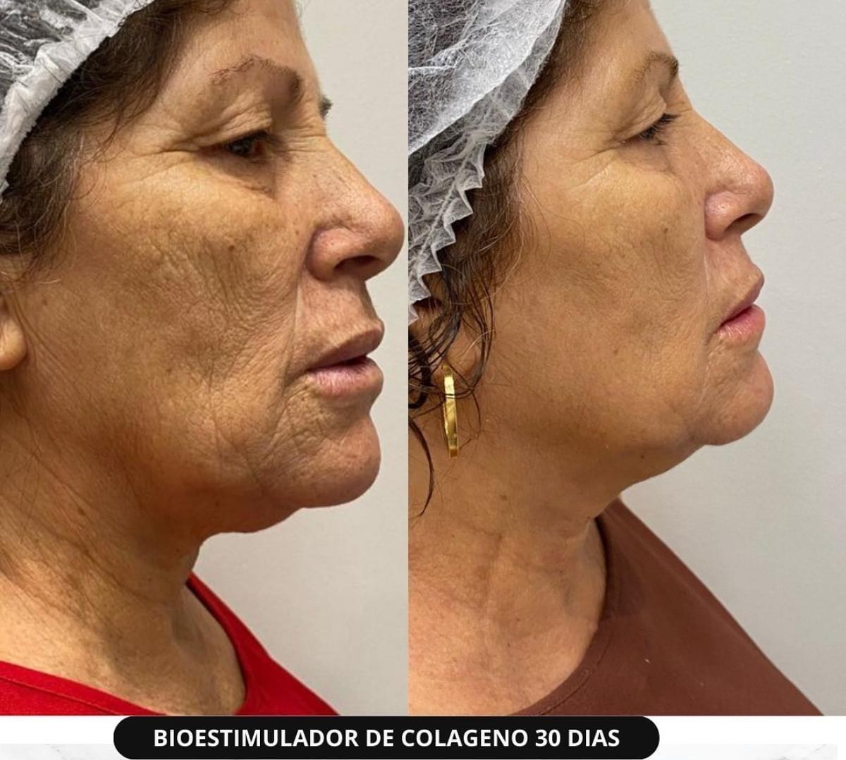 Resultado de bioestimulador de colágeno na Botolifting São José do Rio Preto