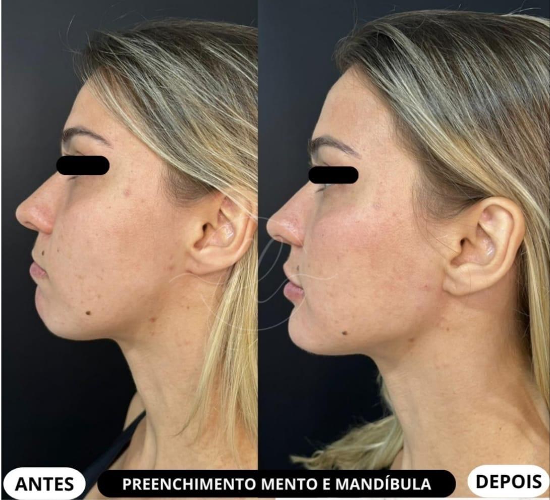 Resultado de preenchimento de mandíbula e mento na Botolifting São José do Rio Preto